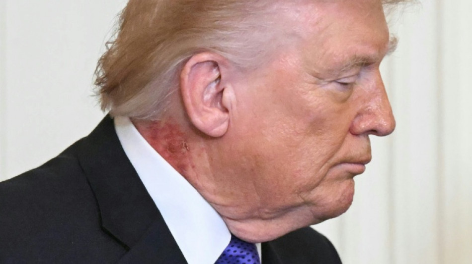 Roter Ausschlag an Trumps Hals sorgt f&uuml;r neue Spekulationen - Arzt nennt "pr&auml;ventive" Behandlung als Grund