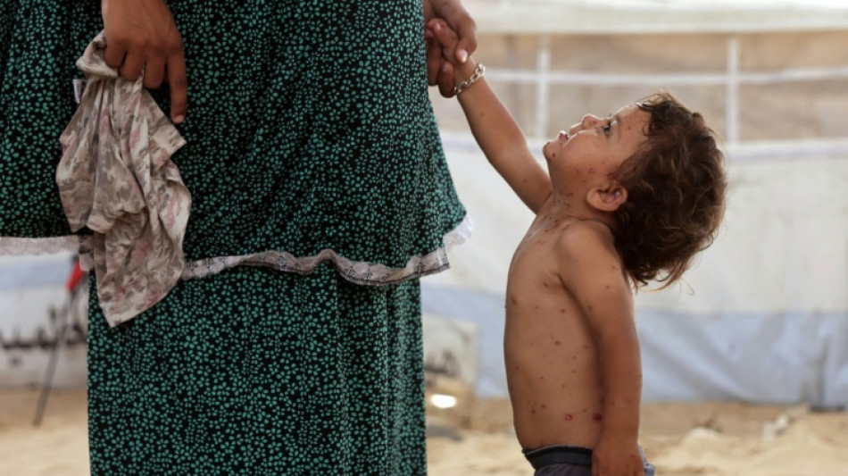Catapora se espalha pelos superlotados acampamentos de deslocados em Gaza